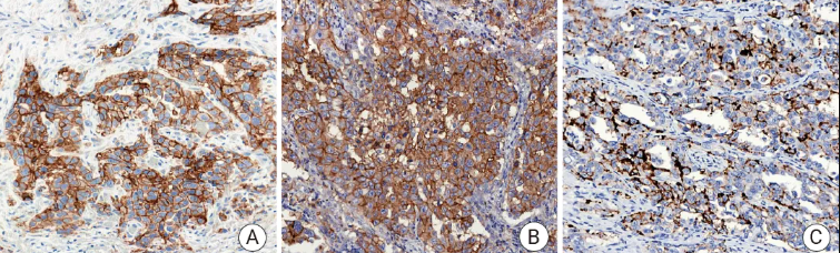 人肺癌组织的 PD-L1 免疫组化分析