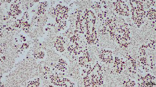 人肺癌组织的 TTF-1 免疫组化分析