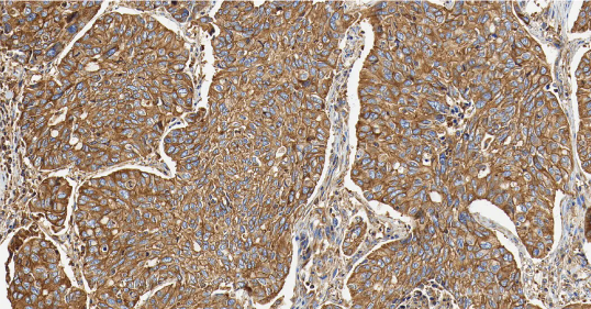 人肺癌组织的 MET 免疫组化分析