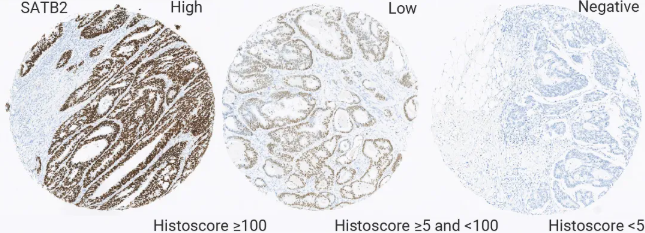 结直肠癌患者 SATB2 免疫染色结果
