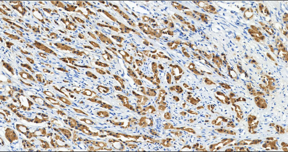 人前列腺癌组织的 PSA 免疫组化分析