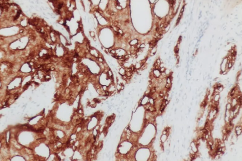 人前列腺癌组织的 PSMA 免疫组化分析